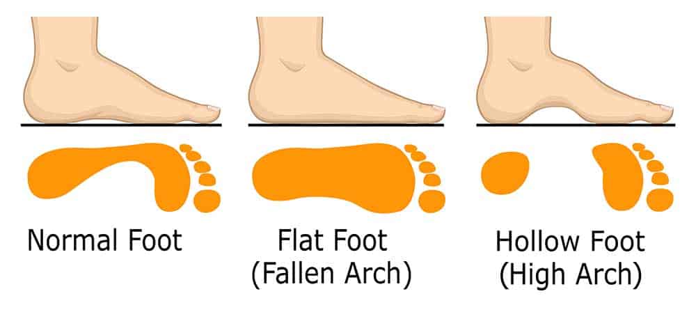 women with high arch, flat and wide feet